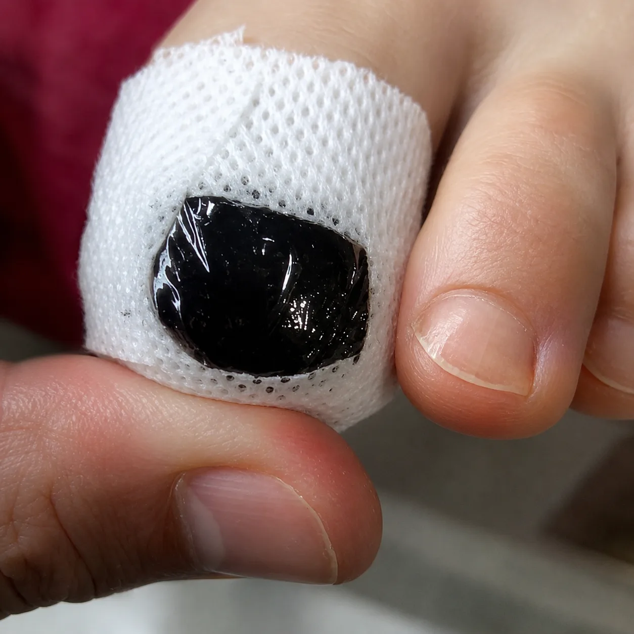 Toenail wrapped with herbal cream and bandage during care cycle