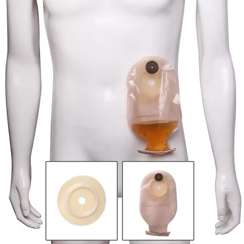 Cómo Cambiar la Bolsa de Ostomía Paso a Paso: Colostomía e Ileostomía